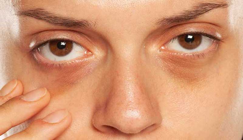 Understanding the Causes of Under Eye Puffiness