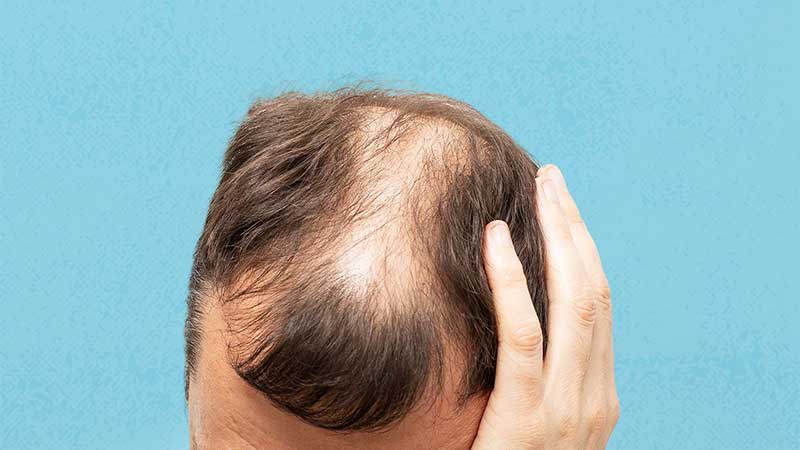 Understanding the Causes of Hair Loss