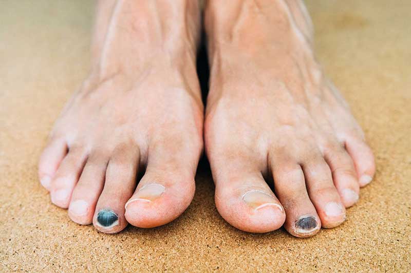 what causes black toenails in diabetics